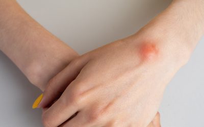 Essential Guide to Skin Lesions, Masses, and Cysts for Better Skin Health