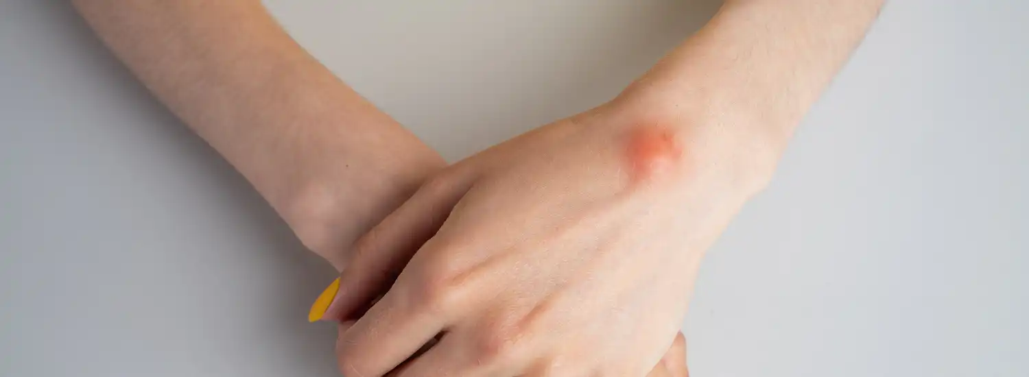 When to remove a skin cyst Skin Lesions, Masses, and Cysts