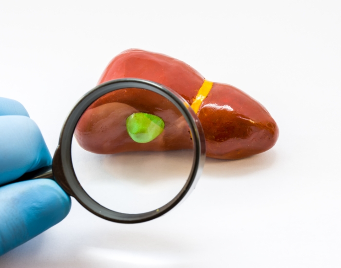 Gallbladder Surgery Cost in Texas | What You Need to Know