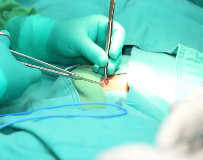 How Long Does Hernia Surgery Recovery Take in Texas Hernia Repair Recovery Timeline in Texas