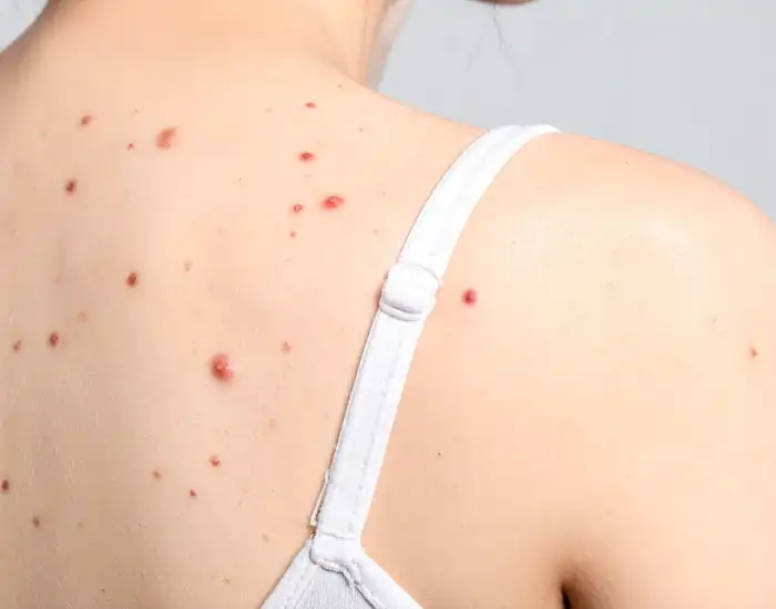 early melanoma symptoms Melanoma Early Signs: What It Looks Like in the Beginning