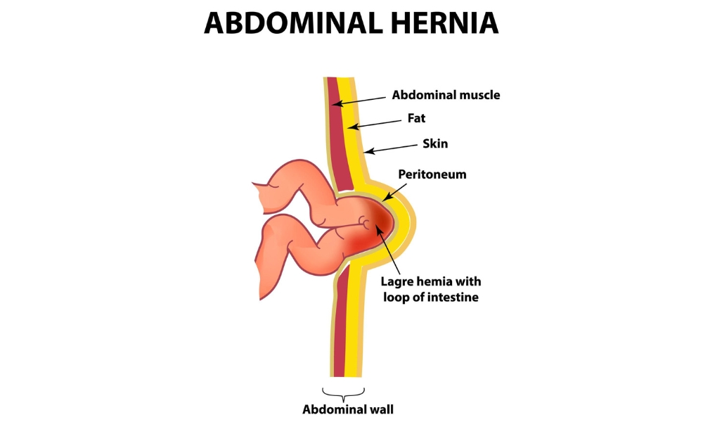Patient discussing hernia treatment options with a surgeon during a consultation